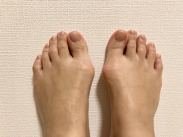 外反母趾の様子